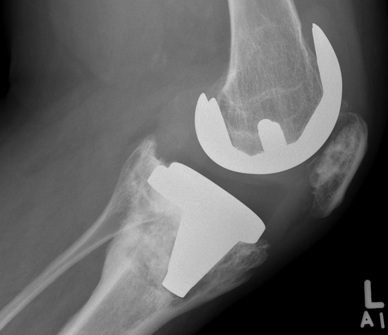 Revision TKR Damaged Tibial Metaphysis